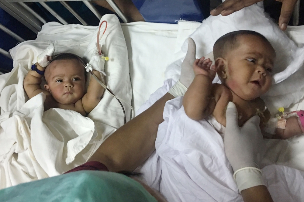Previously-conjoined Bangladeshi twins Tofa and Tahura are treated after surgery to separate them at Dhaka Medical College Hospital in Dhaka on Tuesday. — AFP