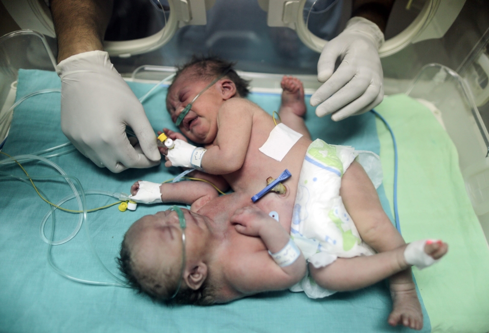 One-day-old Palestinian conjoined twins lie in an incubator at the nursery at Al-Shifa Hospital in Gaza City. — AFP