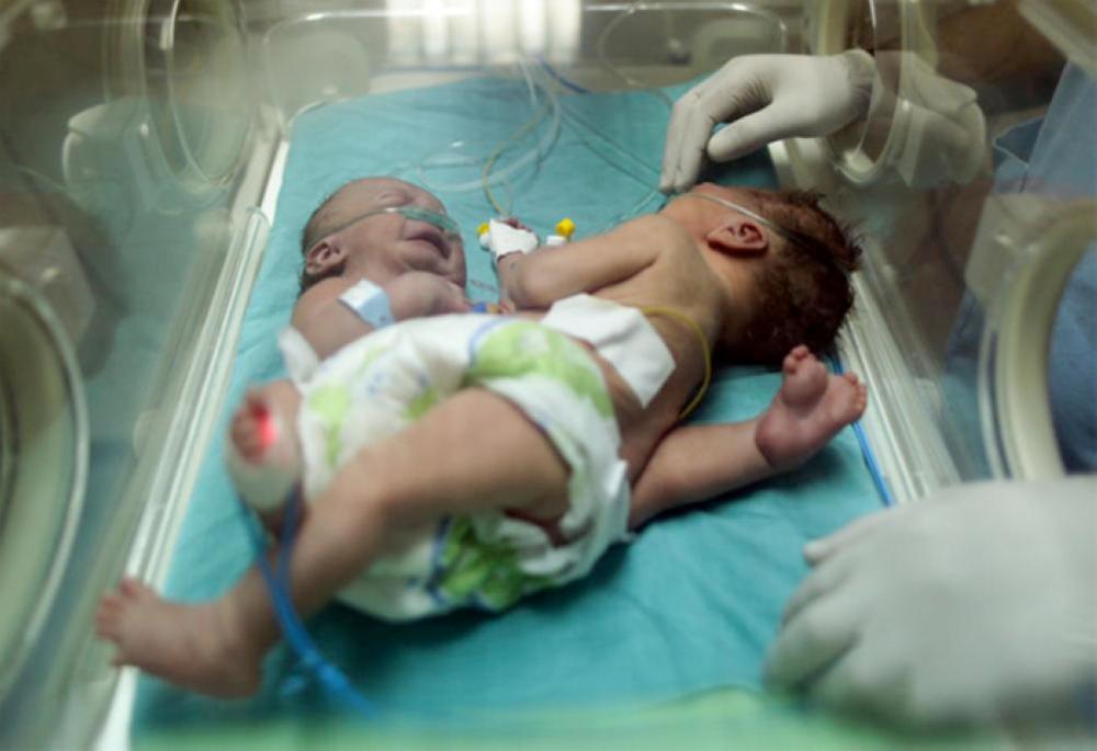 Palestinian conjoined twins airlifted to Riyadh