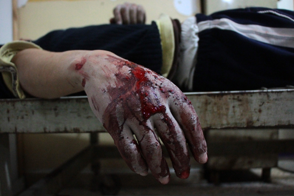 A wounded Syrian lies on a gurney inside a makeshift hospital in the rebel-held town of Douma, following airstrikes by regime forces on the besieged Eastern Ghouta region on the outskirts of the capital Damascus, Tuesday. — AFP