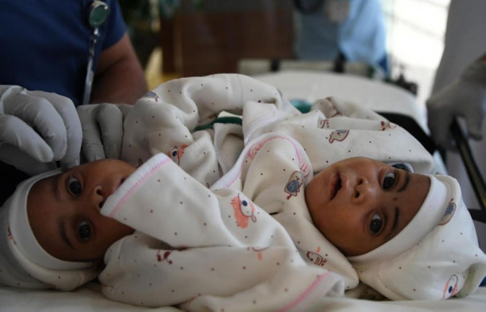 Tanzanian conjoined twins to undergo tests in Riyadh