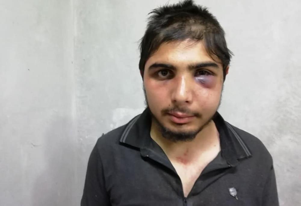 Syrian journalist Mazen Al-Shami shared photos on Facebook and posted a video on YouTube showing injury marks.