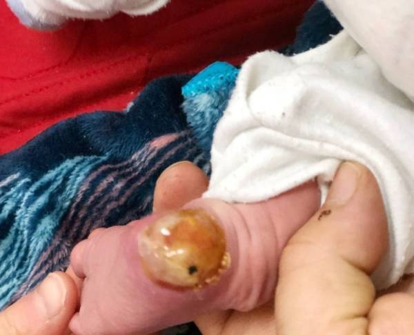 According to a hospital report, Afghan infant Maaz Mohammed Akram suffered deep burns in his right foot.