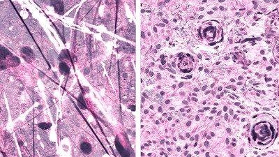 Stimulated Raman histologic images of diffuse astrocytoma (left) and meningioma (right). — Courtesy photo