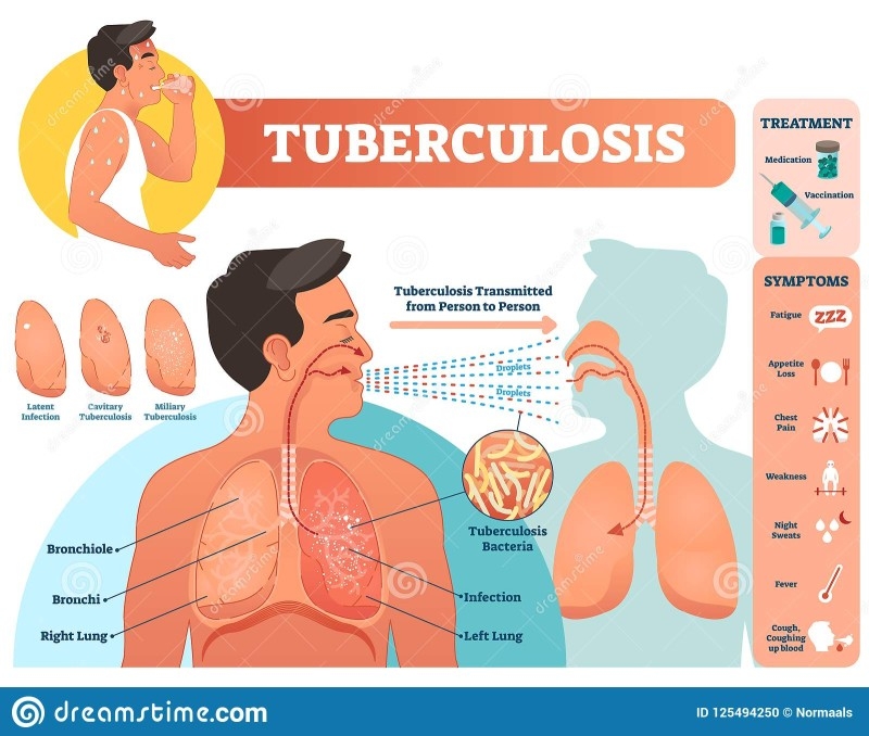Tuberculosis Deadliest Infection Of The 21st Century So Far Saudi Gazette