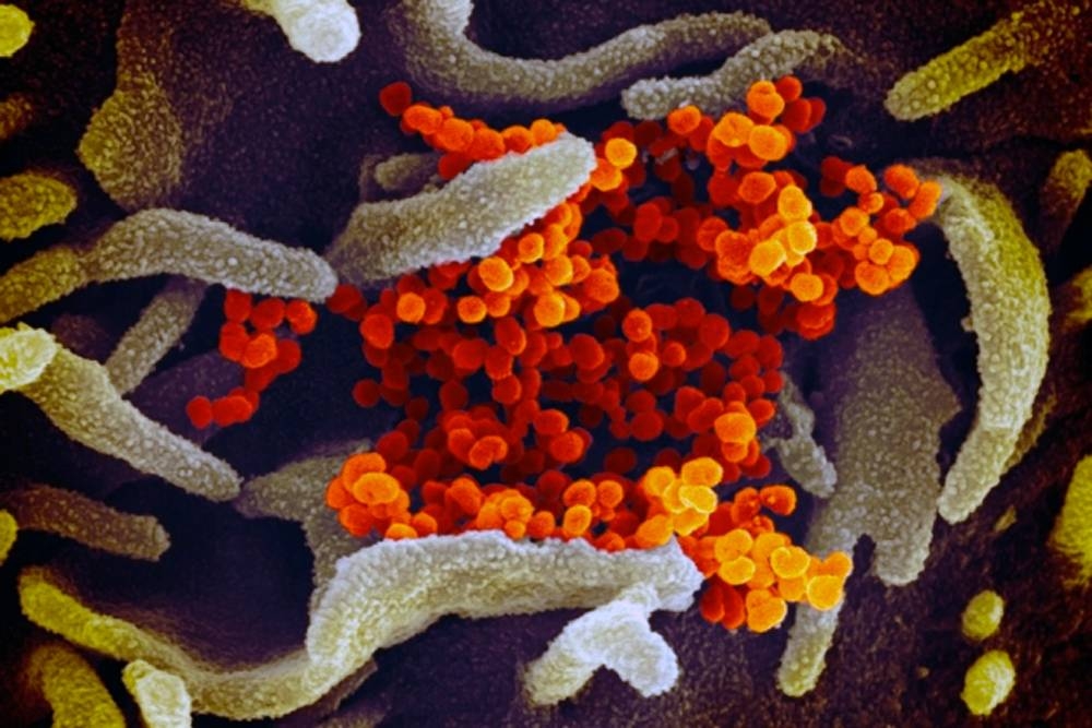 This scanning electron microscope image shows SARS-CoV-2 (orange) — also known as 2019-nCoV, the virus that causes COVID-19 — isolated from a patient in the US, emerging from the surface of cells (green) cultured in the lab. — Courtesy NIAID-RML
