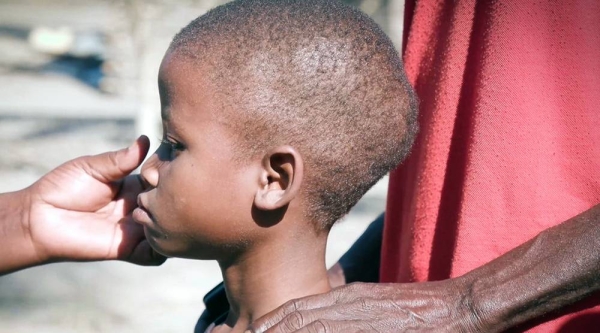 Anísio, who was born with HIV, has problems with the treatments because he is malnourished. — courtesy UN News