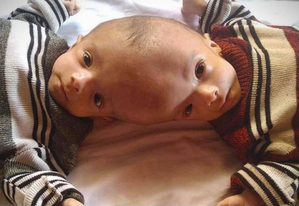 Custodian of the Two Holy Mosques King Salman has ordered for the transfer of Yemeni Siamese twins 