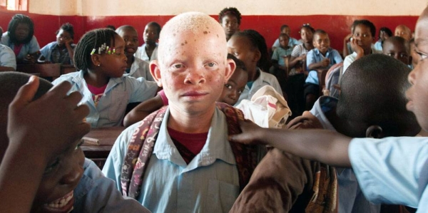Lucas and his brother both have albinism, which makes their skin very sensitive, their eyesight poor, and their appearance a little different from their brothers and sisters. — courtesy UNICEF