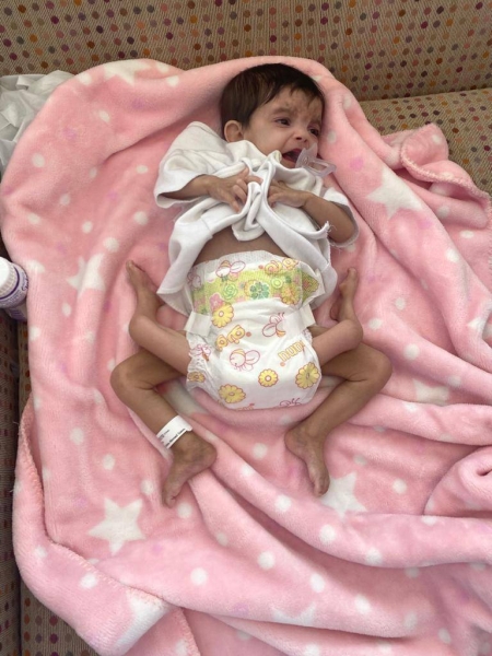 Surgical separation of conjoined twin Ayisha to be held Thursday