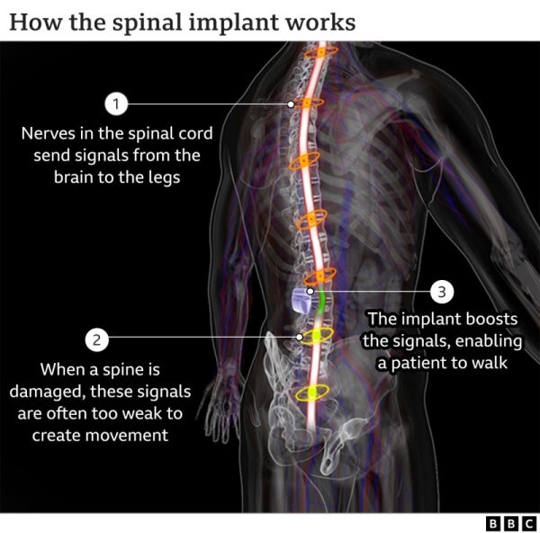 Spinal implant allows Michel Roccati to walk.
