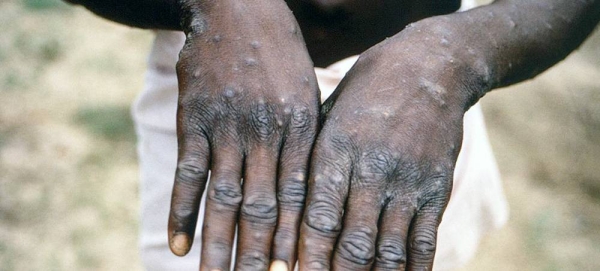 A young man shows his hands during an outbreak of monkeypox in the Democratic Republic of the Congo. — courtesy (file)CDC