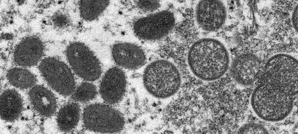 Monkeypox is a rare but dangerous infection similar to the now eradicated smallpox virus. — courtesy CDC/Cynthia S. Goldsmith