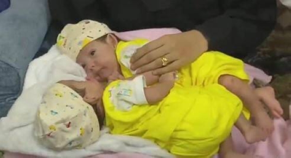 In implementation to the directives of Custodian of the Two Holy Mosques King Salman, a medical team has arrived on Sunday in a medical evacuation plane at Aden Airport in southern Yemen to transport the Yemeni conjoined twins Mawaddah and Rahma to Riyadh.