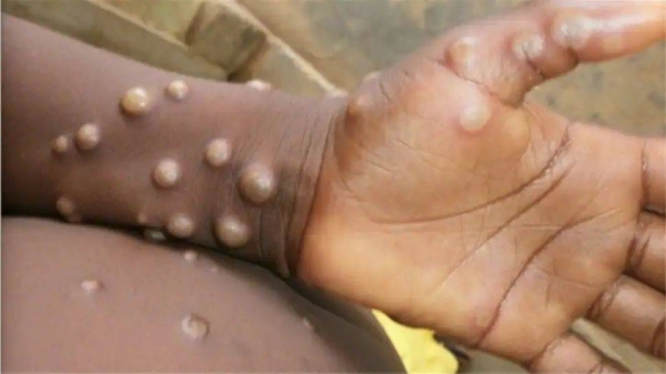 World faces formidable challenges as monkeypox spreads: WHO