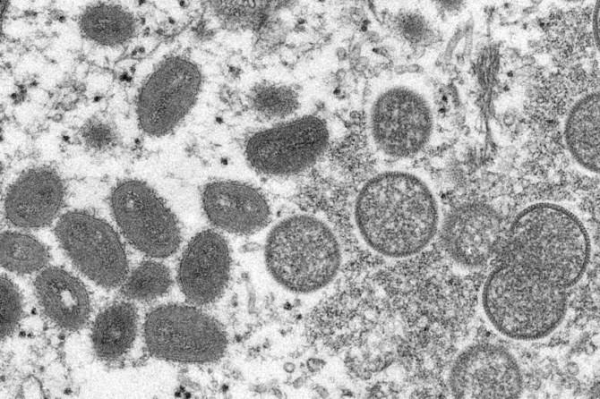 First monkeypox case detected in UAE