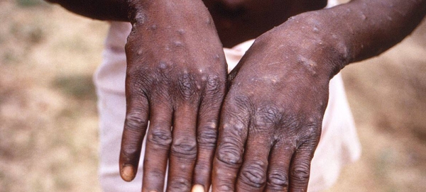 A young man shows his hands during an outbreak of monkeypox in the Democratic Republic of the Congo. (file).