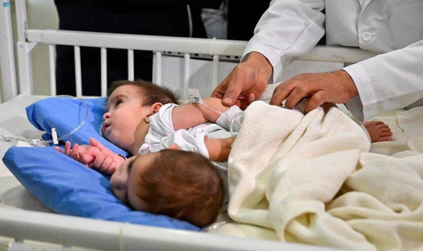 11-hour surgery to separate Iraqi conjoined twins Ali and Omer begins in Riyadh