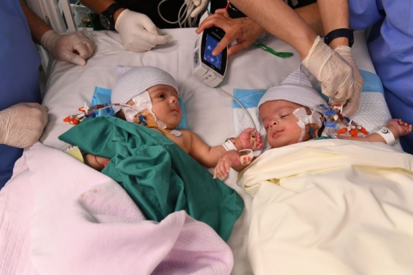 Salman and Abdullah -the conjoined Yemeni twins- underwent successful surgical separation on Thursday.