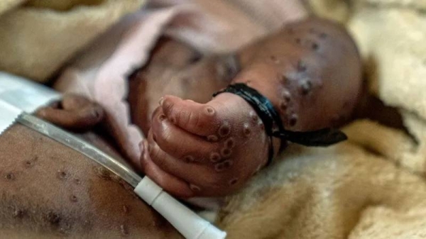 Medics plead for vaccines in DR Congo’s mpox battleground